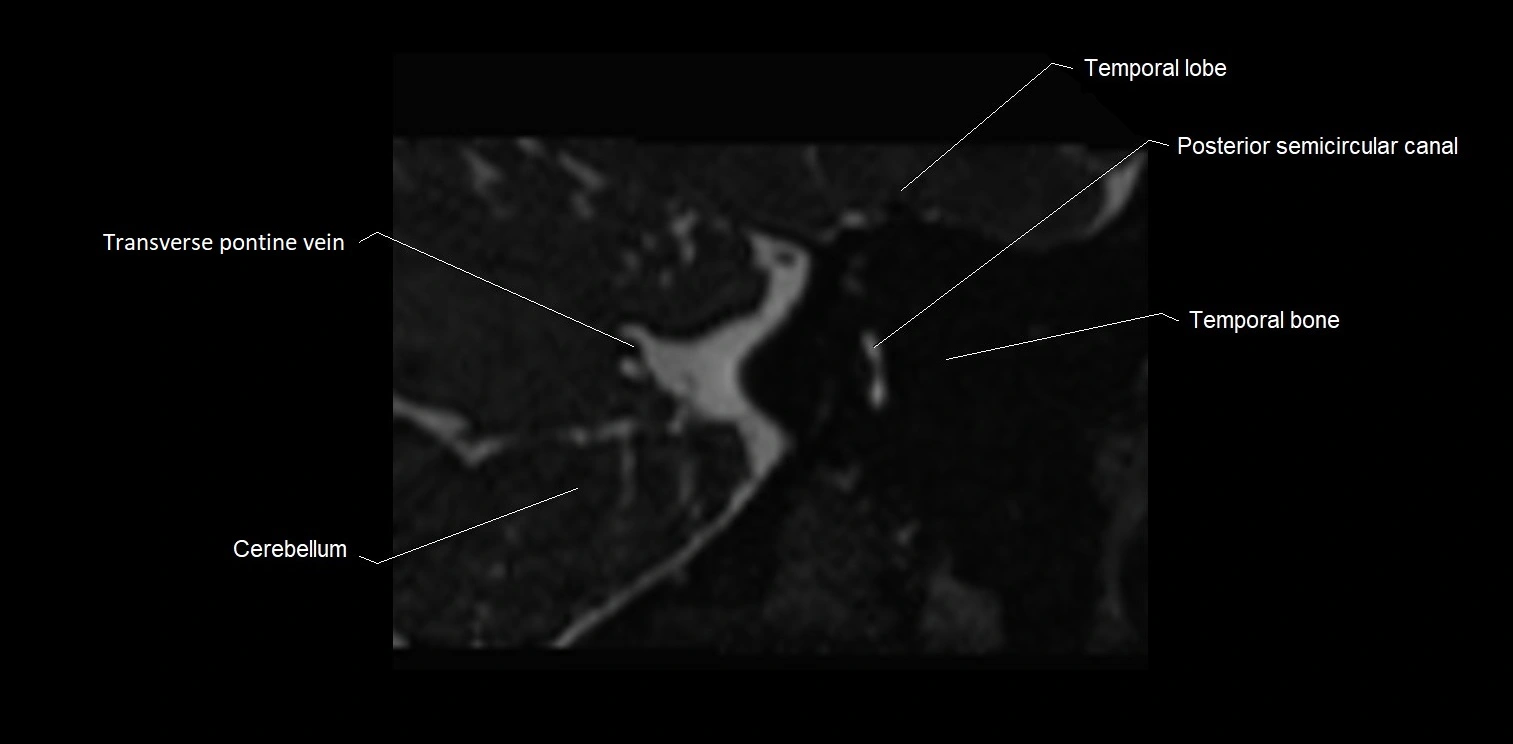 MRI Internal auditory meatus (IAM) coronal cross sectional labelled anatomy image 32.webp